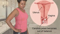 Vaginal Yeast Infection (Thrush)