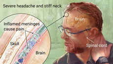 meningococcal