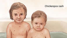 Chickenpox