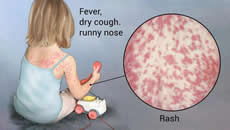 Measles